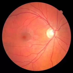 Say Cheeeeeeese! Why taking a photo of your retina is super important.